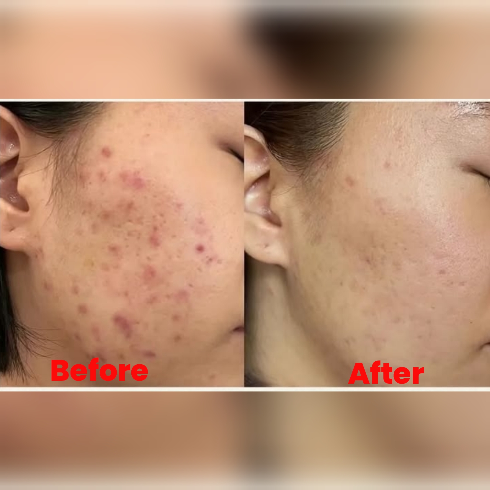 Korean Herbal Acne Facial