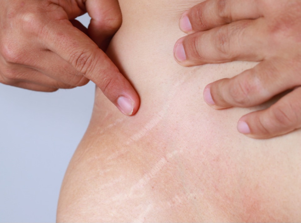 Inkless Stretch Mark Removal