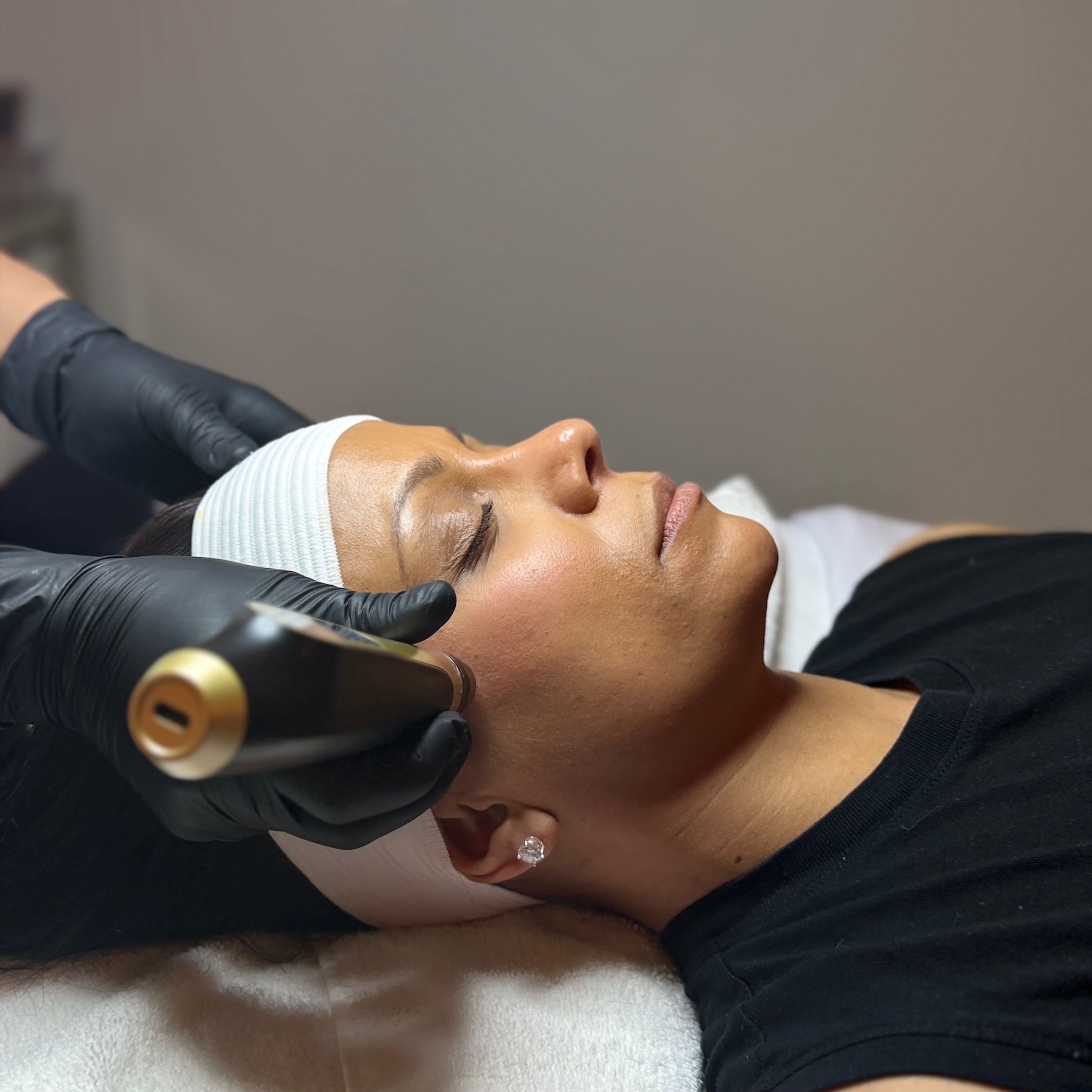 Collagen Induction Therapy at Tillie's Skincare Studio in Rockland, MA