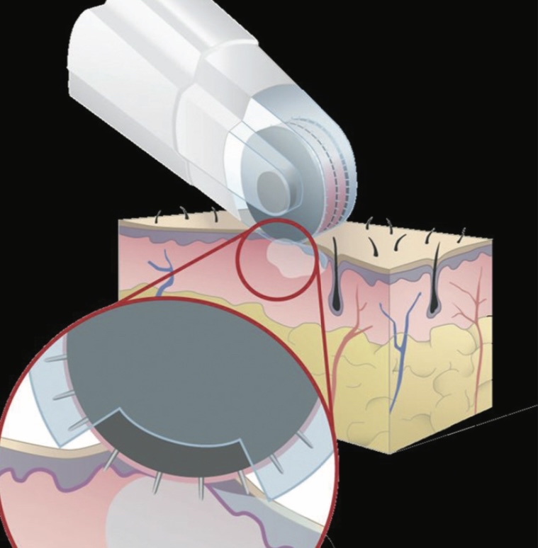 Micro-Infusion Hand & Foot