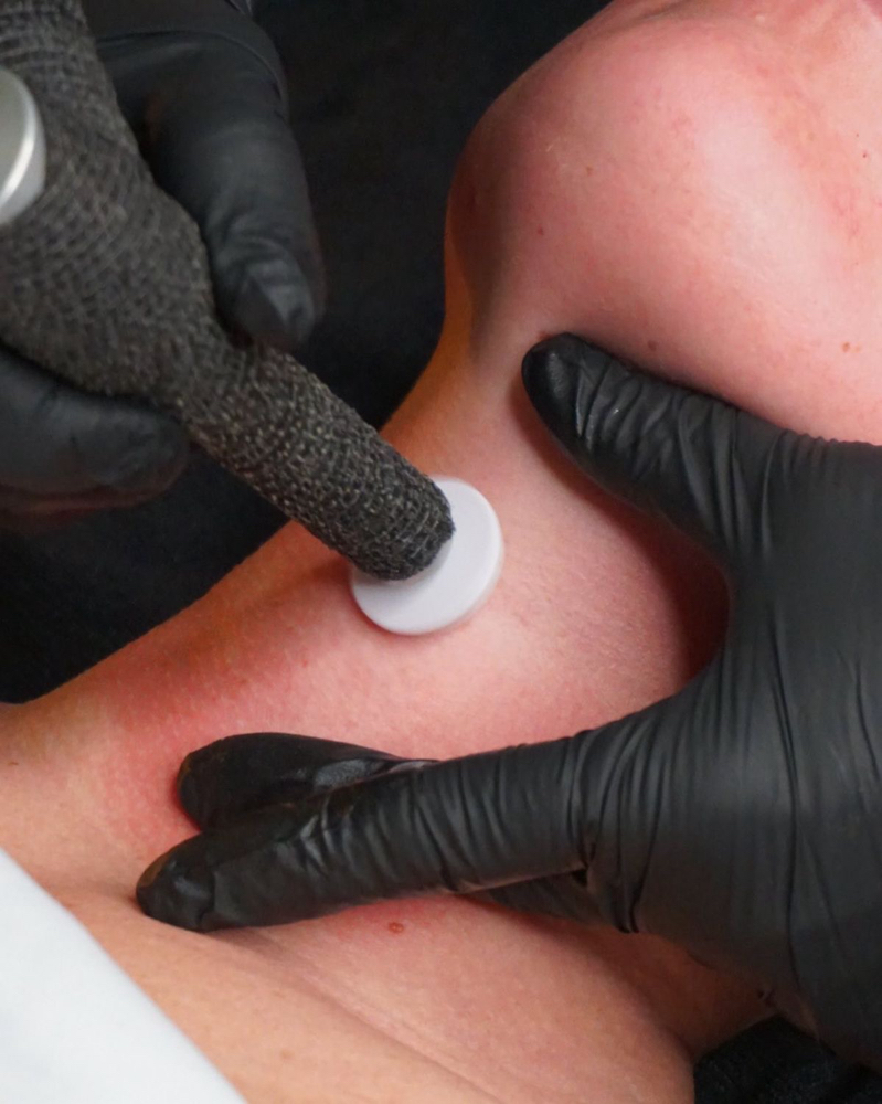 Microchanelling (Procell therapies)