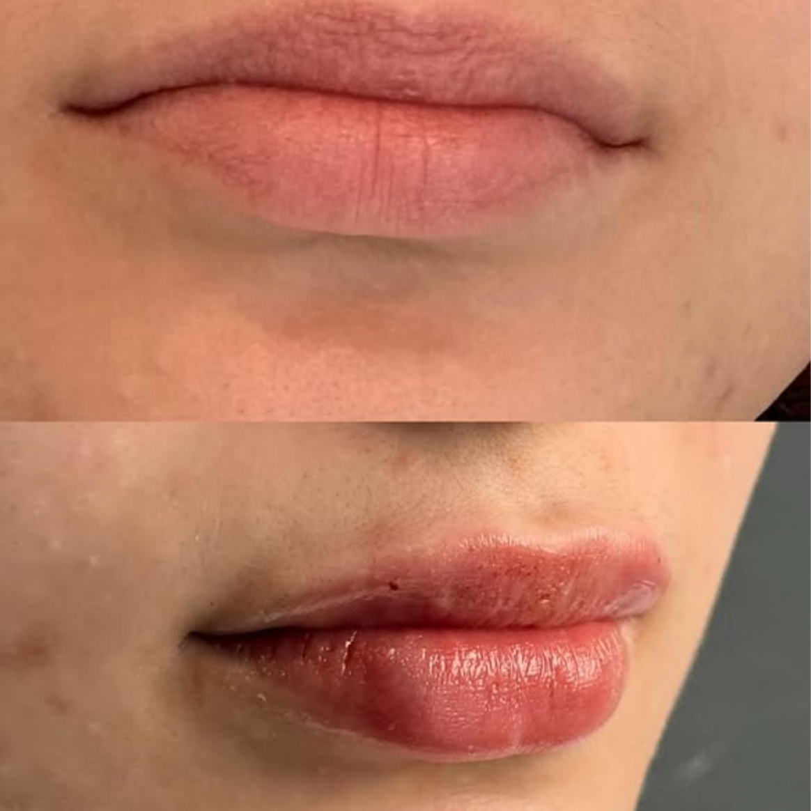 Lip Filler at TRES Aesthetics in Missouri, TX