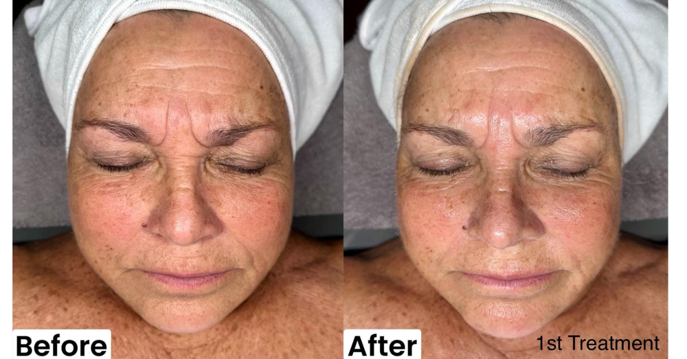 Facial Con Oxigeno