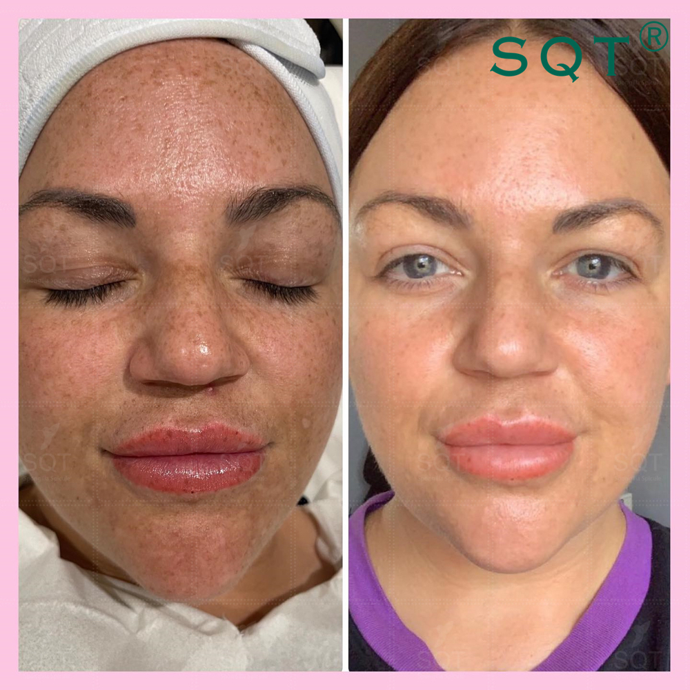 SQT Revitalizing(hyperpigmentation)