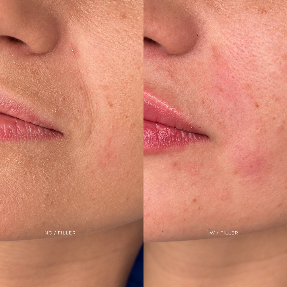 FILLER | NASOGENIANOS at EROXSPA in Houston, TX