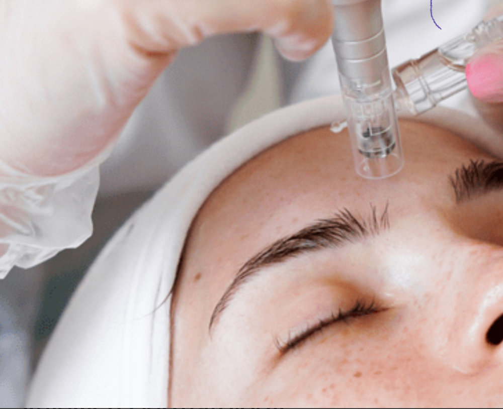 Microneedling