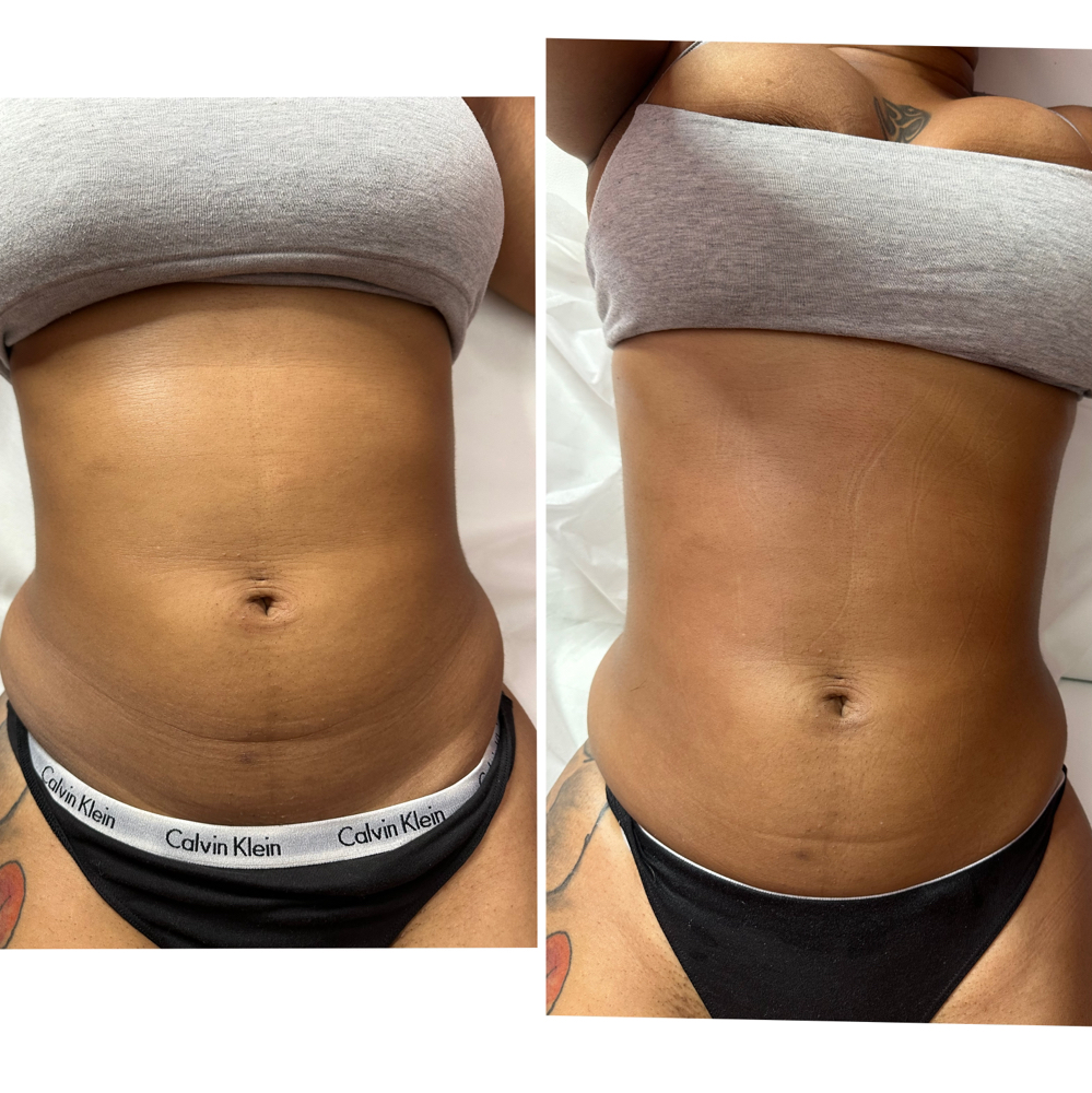 5Treatments Stomach/back at Eygptian Esthetics in Upper Marlboro, MD