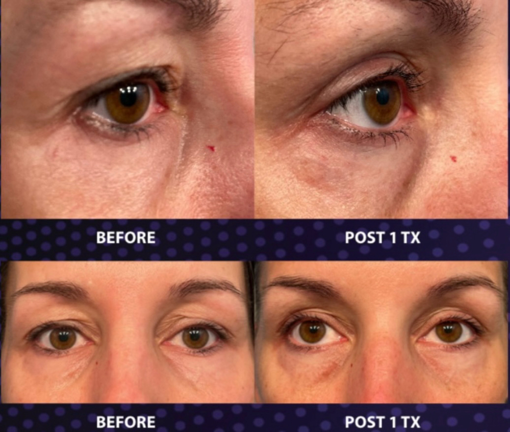 Treatment for Dark Circles Under th