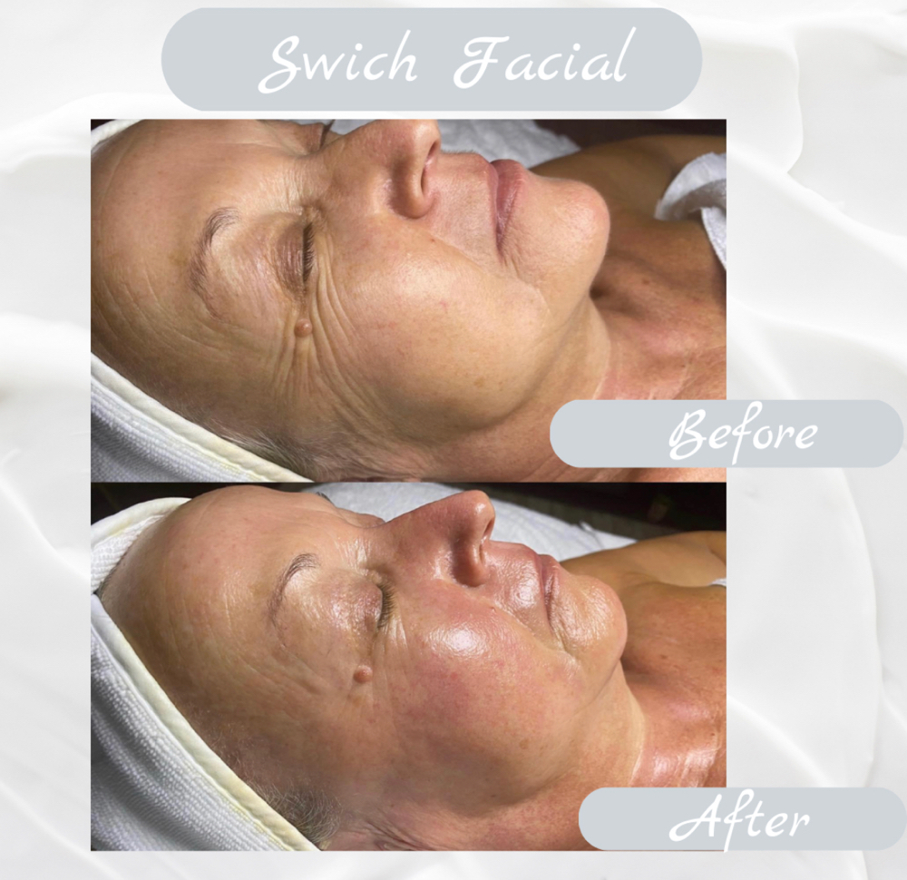 SWiCH Anti Aging Treatment