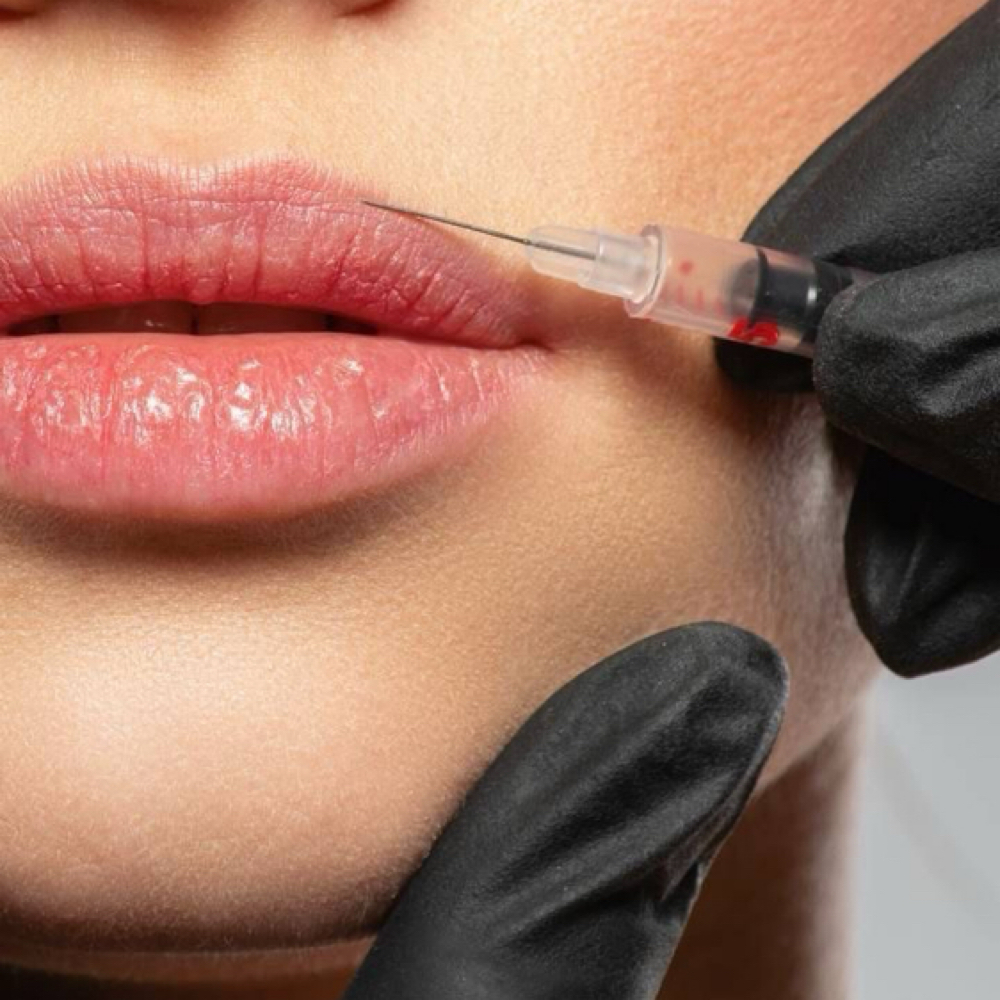 Lip Filler- Half Syringe at Southern Luxe Aesthetics in Livingston, TX
