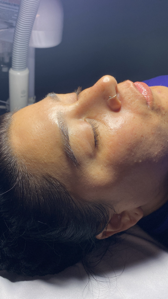 Chemical Peel