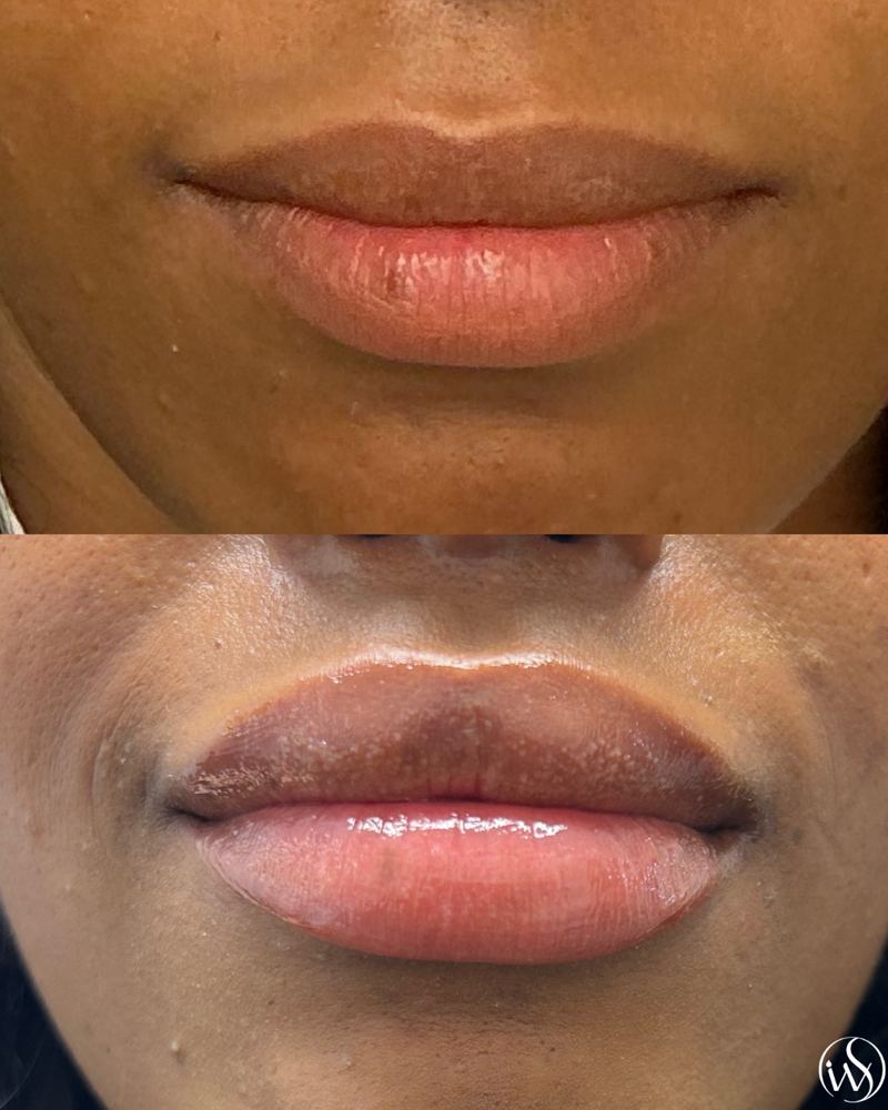 Lip Filler - 1 Syringe