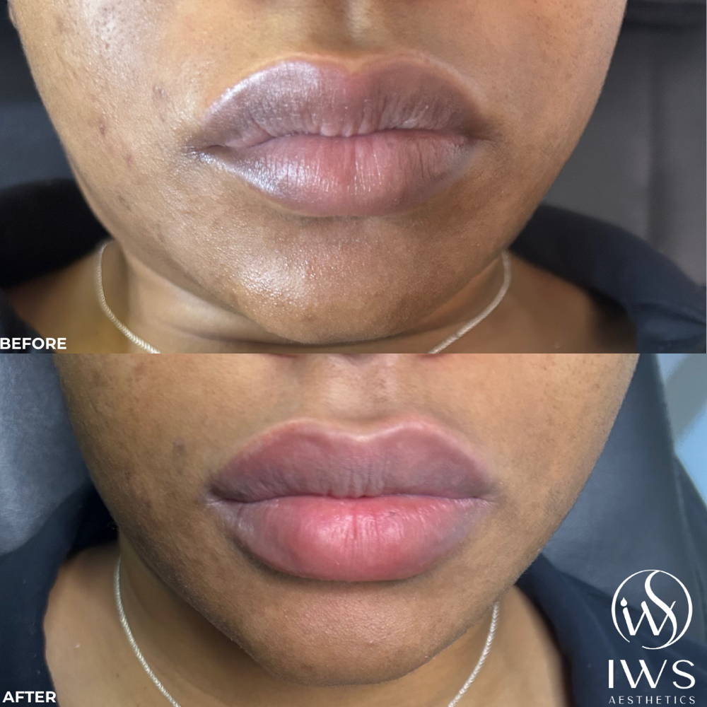 Lip Filler - 1 Syringe