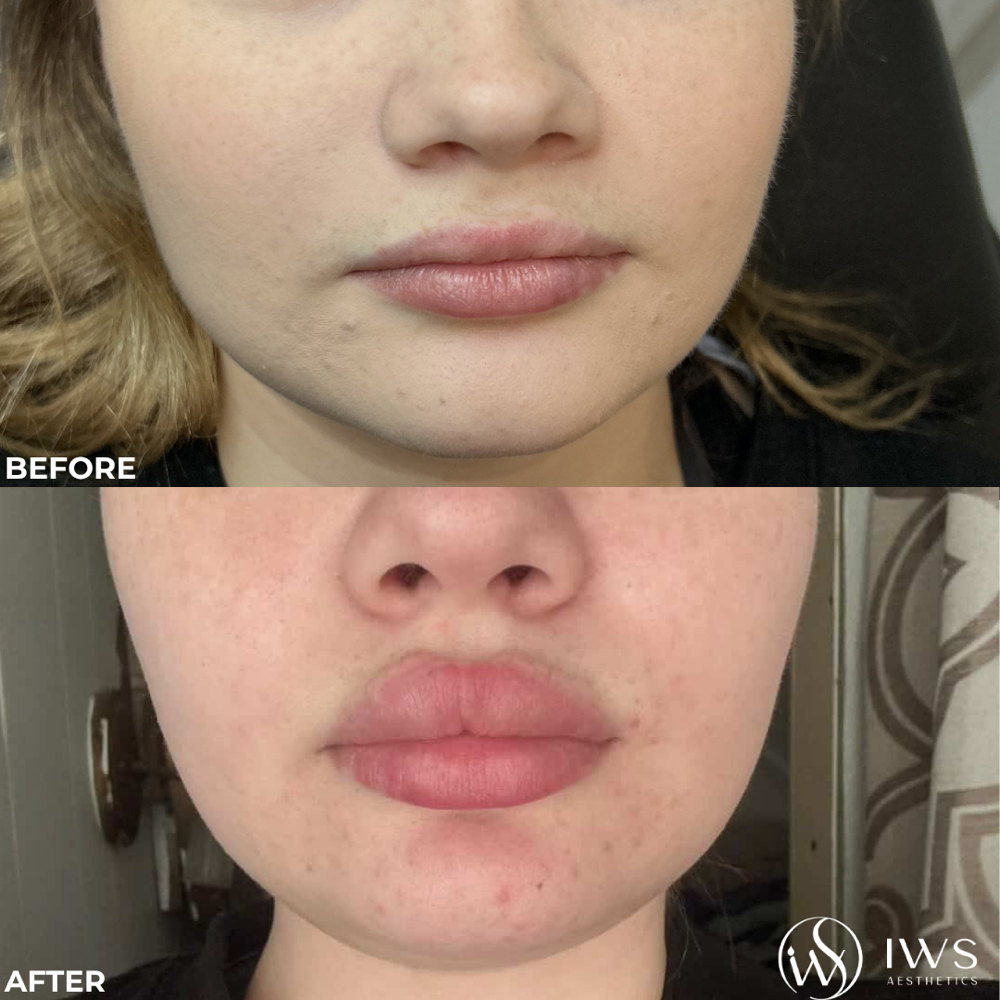 Lip Filler - 1 Syringe at IWS Aesthetics, PLLC in Detroit, MI