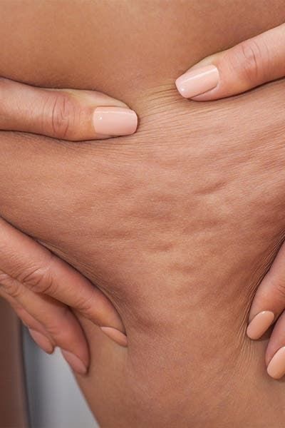 Body Sculpting For Cellulite