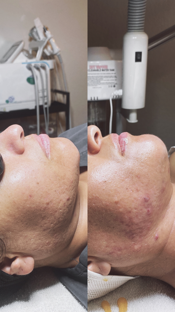 Chemical Peel (Beginning)