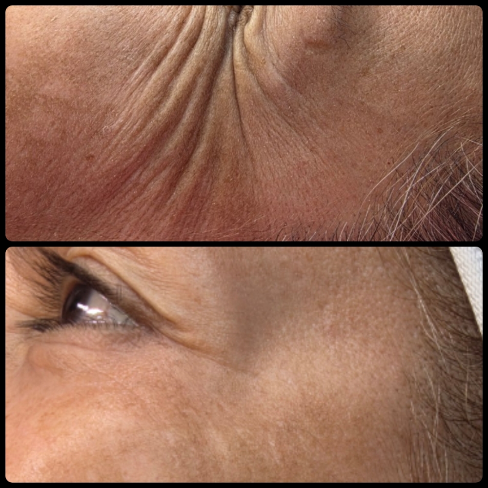 Tox Services at Glass Face Aesthetics LLC in Fort Stockton, TX
