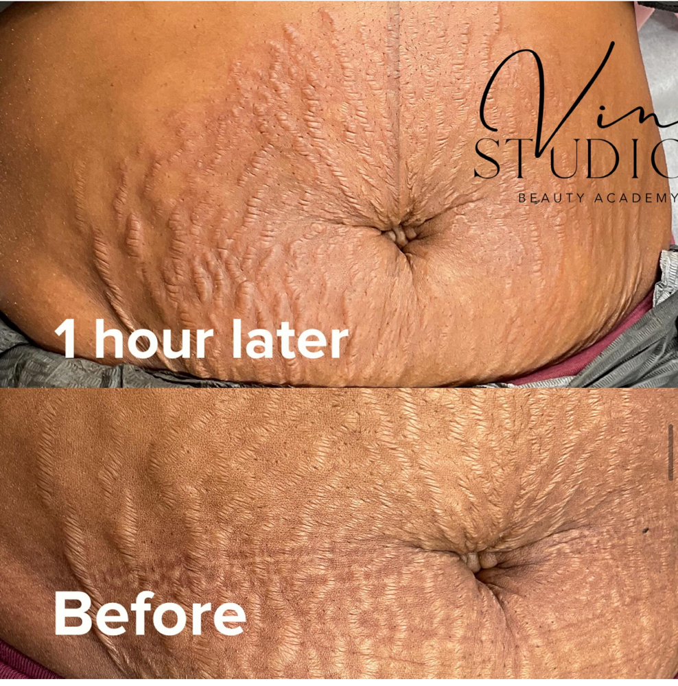 Medium Stretch marks "Eraser" - PMU at VINE Studios Permanent Cosmetics in Maple Valley Wa, WA