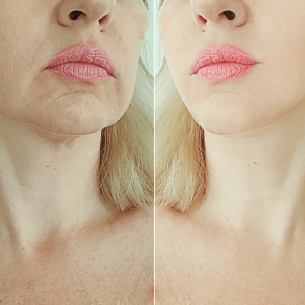 Neurotoxin Lower Face Lift at Beauty Lounge Prosper in McKinney, TX