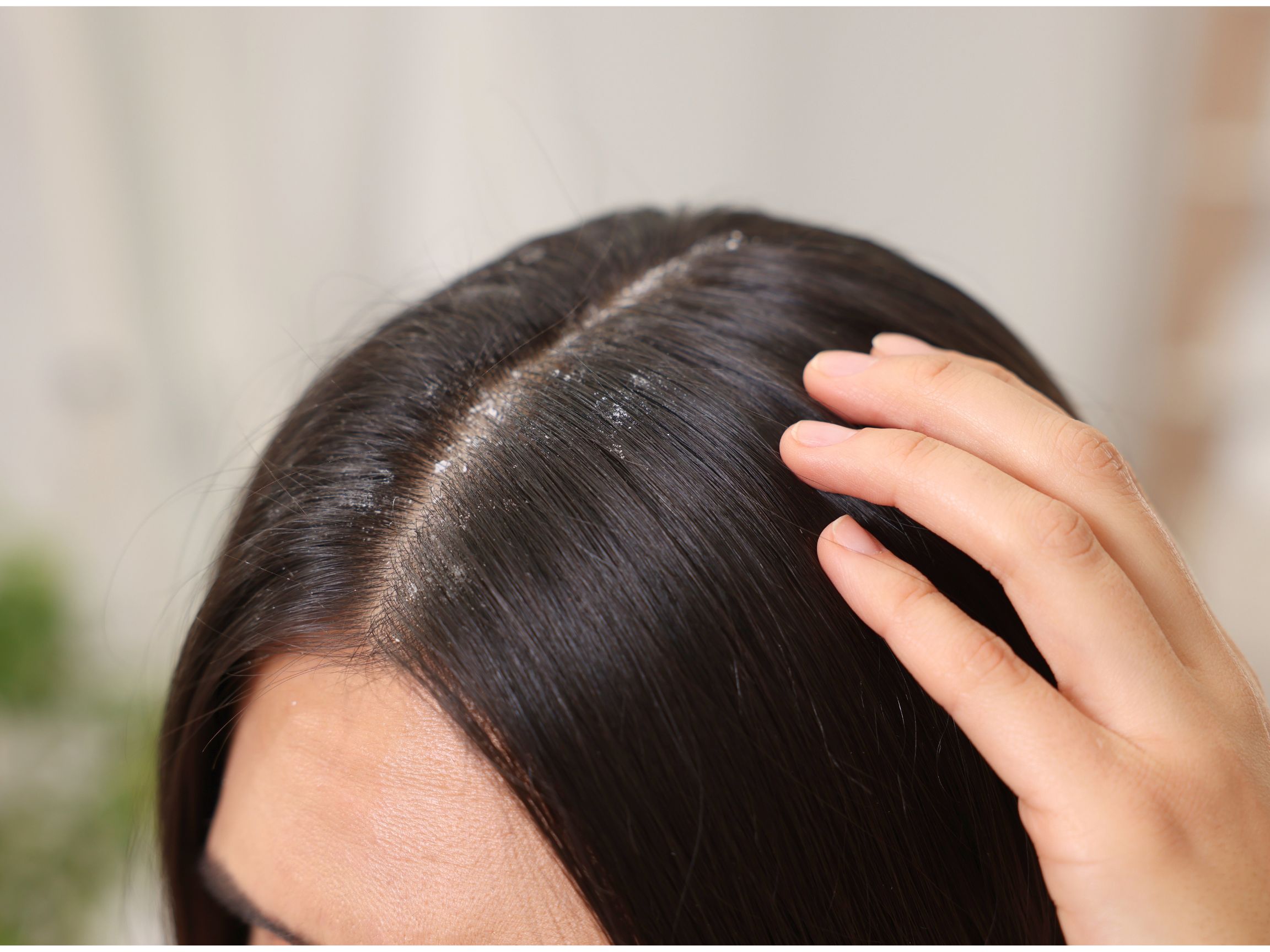 Dandruff/Scalp Rebalance Treatment