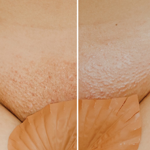 Hydrogel Vajacial Mask - De Luxe at Bareline Aesthetics in Brea, CA