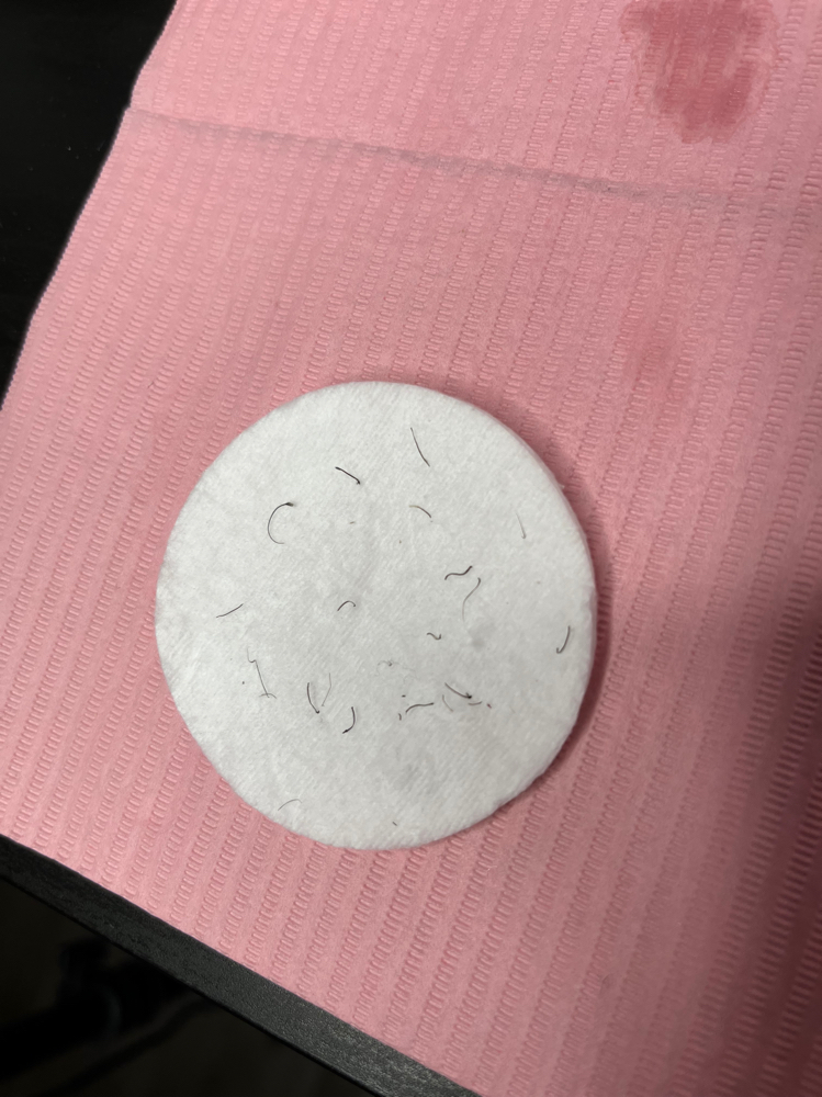 Ingrown Extractions