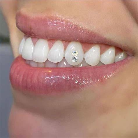 Tooth Gems (Swarovski)