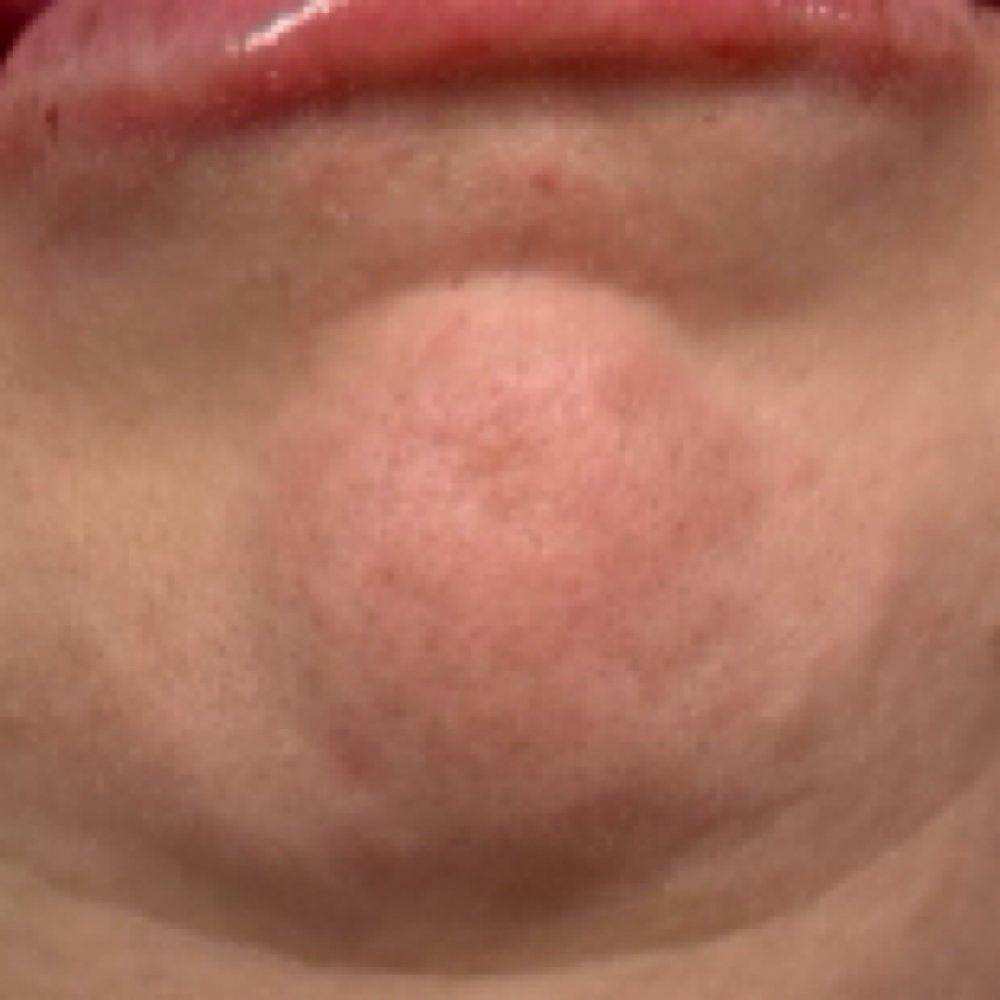 Chin Tox at Nouvelle Vie Beauty in Cibolo, TX