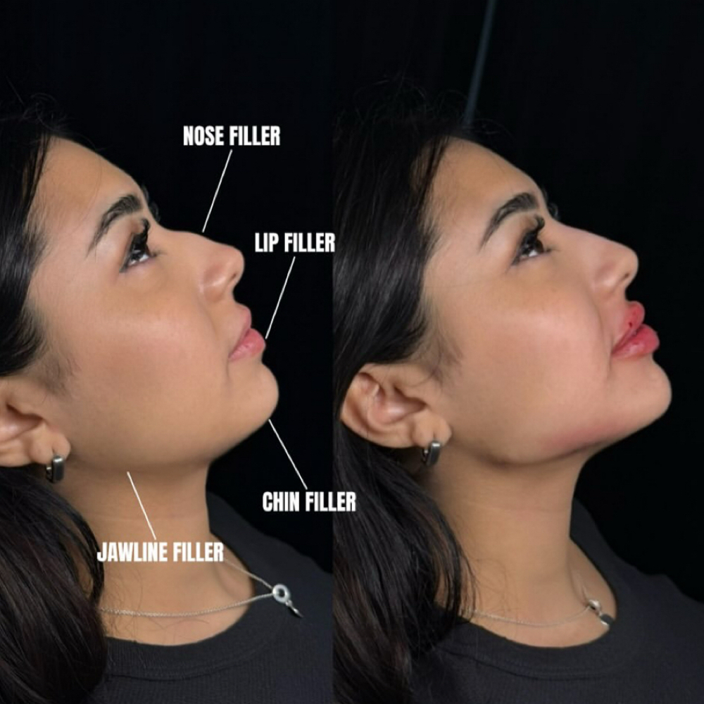 Facial Balancing at Royale Medical Aesthetics and Wellness in Cheyenne, WY