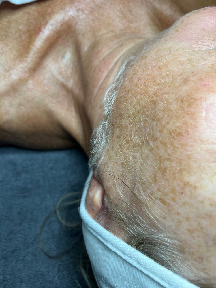 Dermaplane Add On