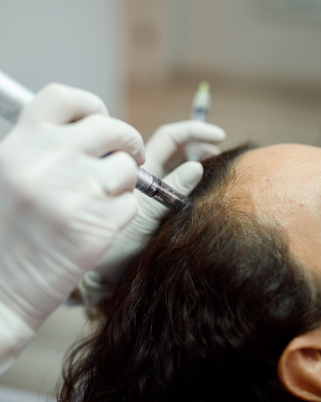 PRP Hair Restoration - Single Spin