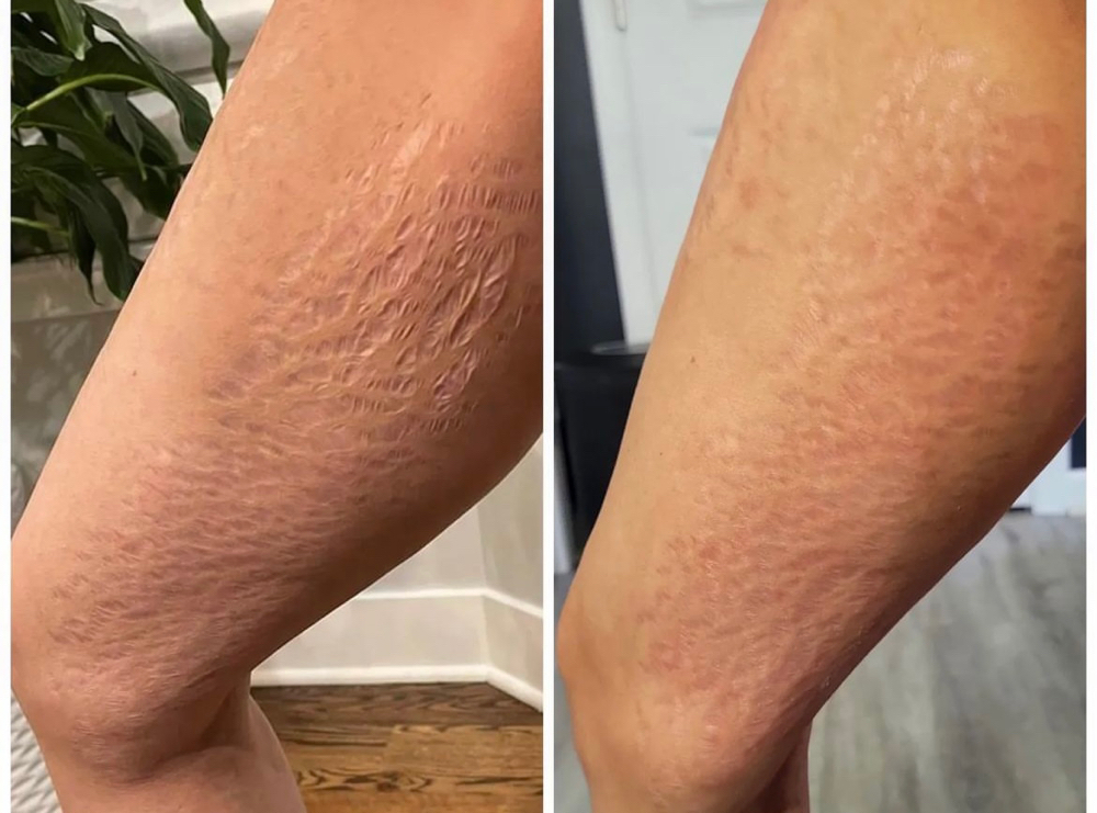 INKLESS Stretch Mark rejuventstion at Ideal Ink Lab in Miami, FL
