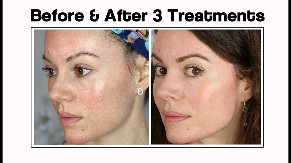 AURORA COLLAGEN RESTRUCTURE at Auroura Skin & Smile in Worcester, MA