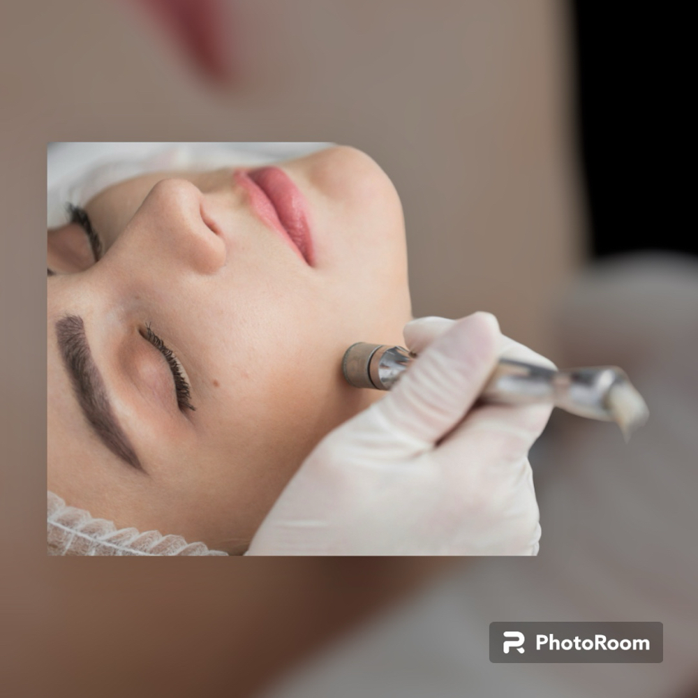 Microdermabrasion