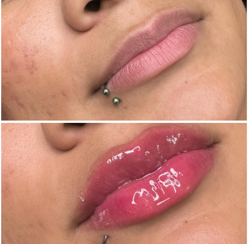 Hyaluronic Lip Filler Model
