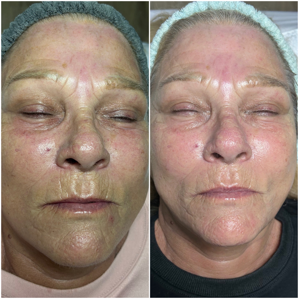 Mid Level Peel