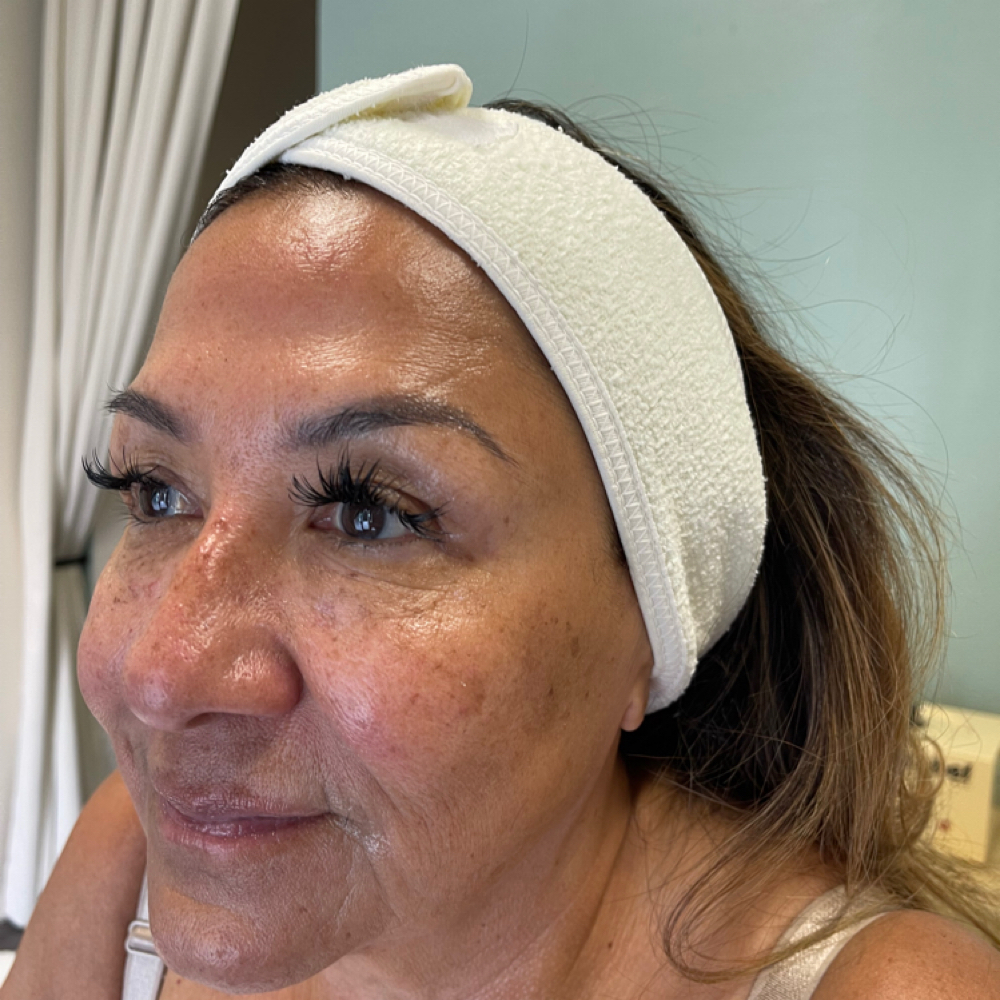 Hyper Pigmentation/ Melasma Facial at On The Brite Side Of Skin in Rancho Cucamonga, CA