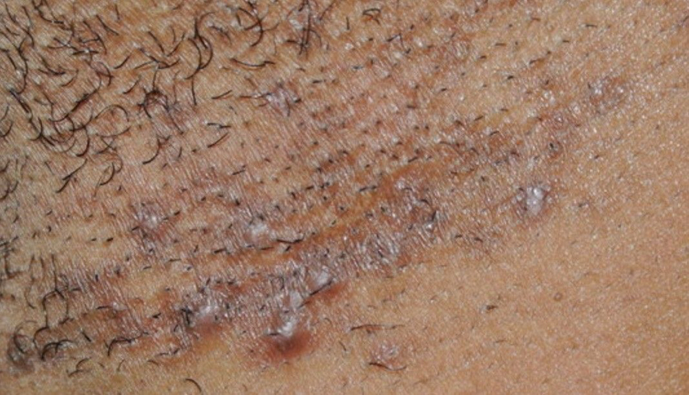 Ingrown Hair Removal