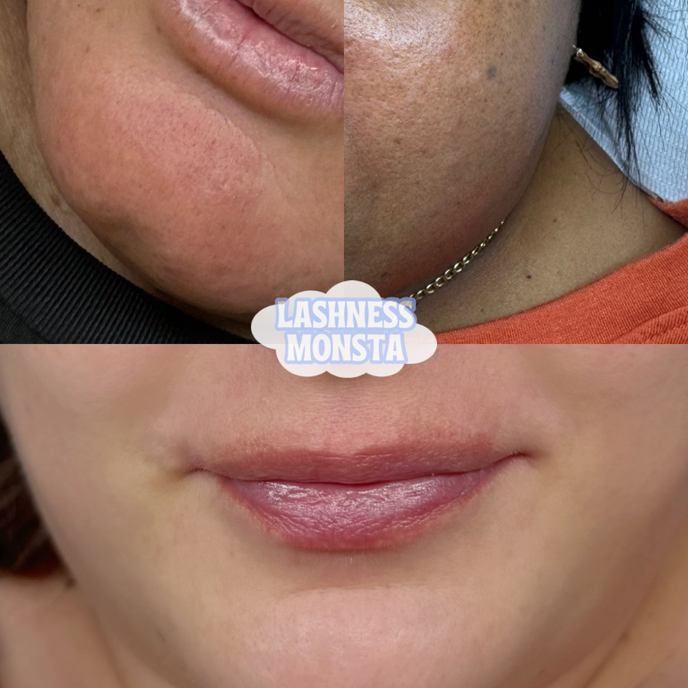Lip+Chin+Sides