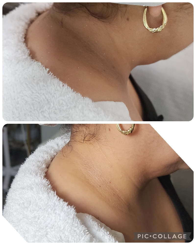 Cuello Despigmentacion at BELLALOTOMH  beauty lash studio in Beltsville, MD