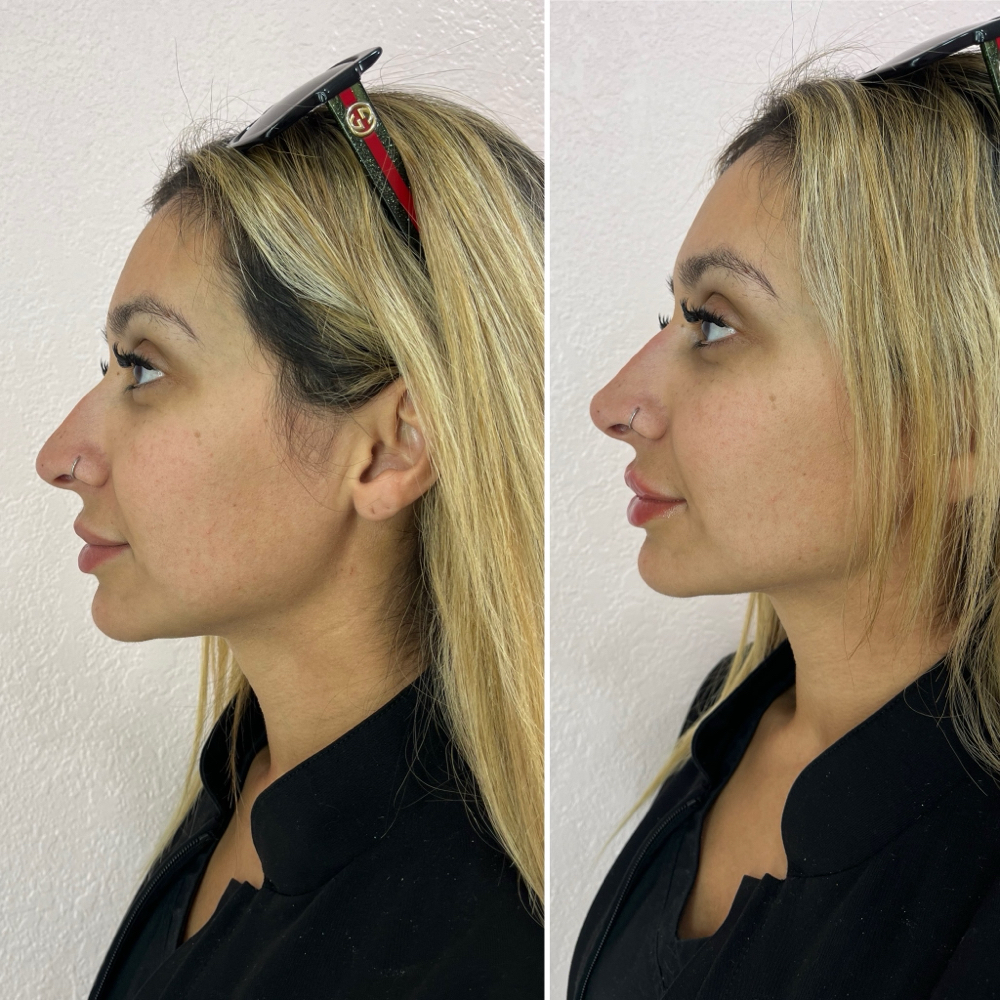 Non Surgical Nose Filler