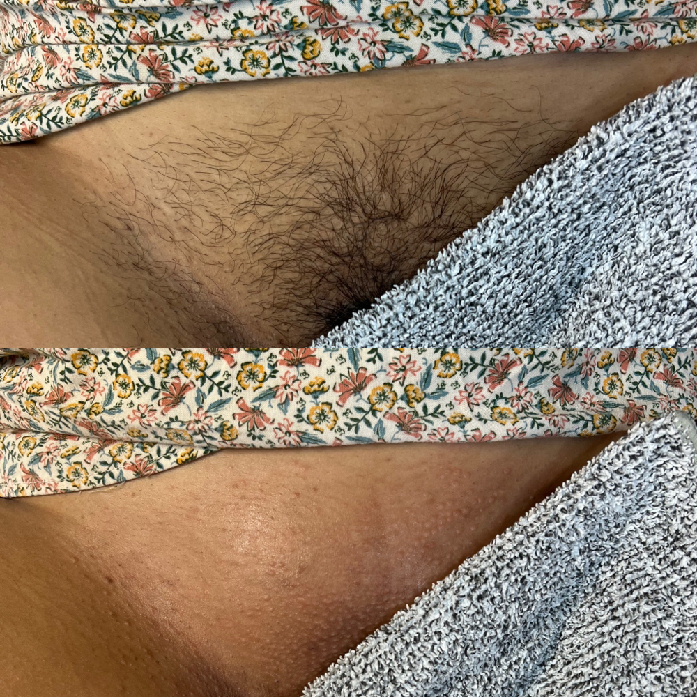 Brazilian Wax