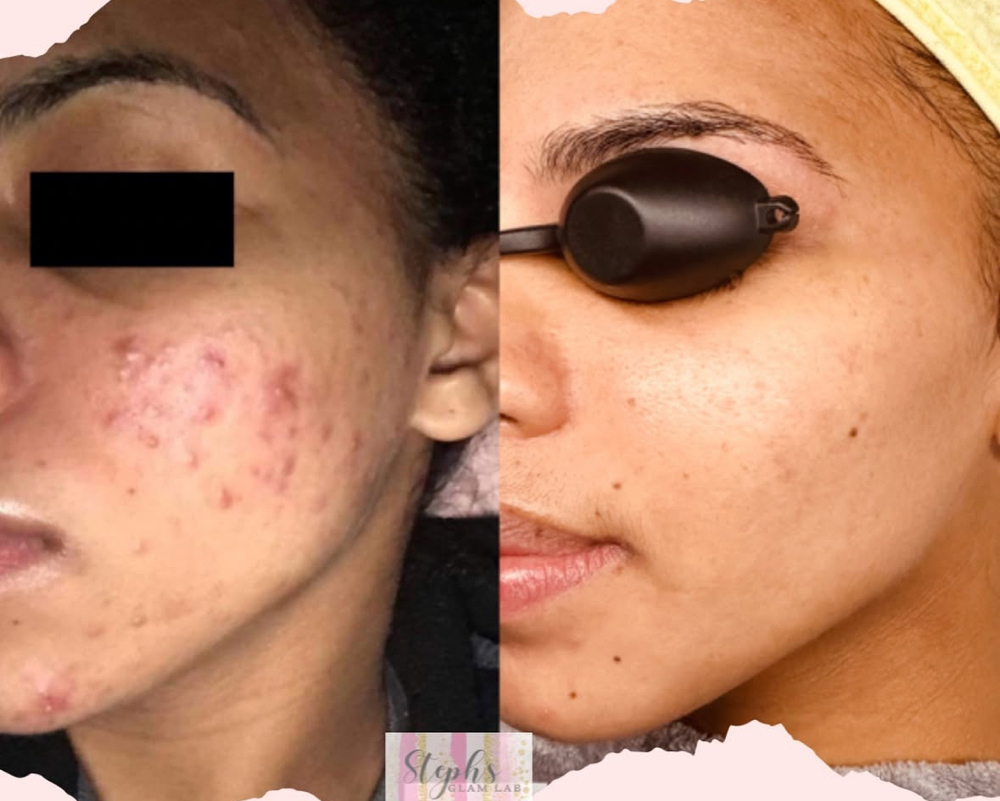 Acne Healing Facial *NEW*