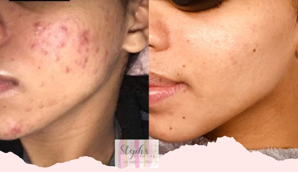 Acne Healing Facial *NEW*