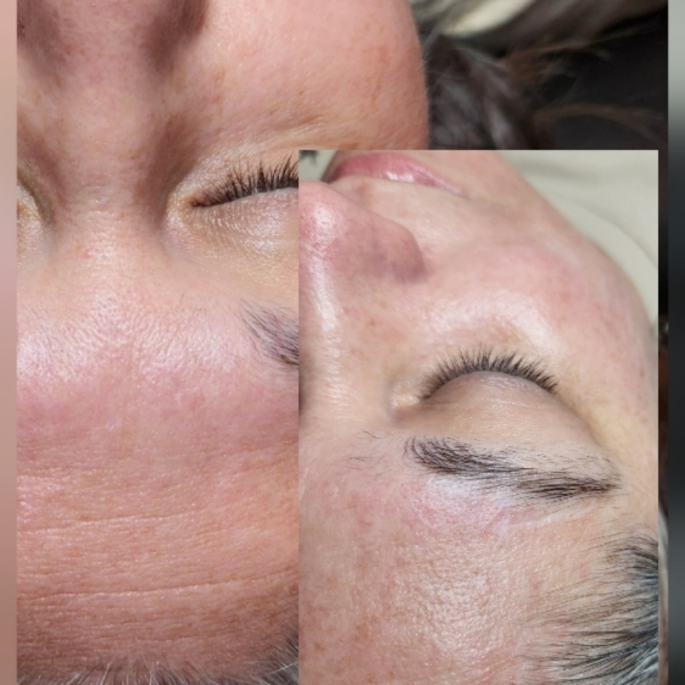 Signature Rejuvenation at Evermore Esthetics in Gravette, AR