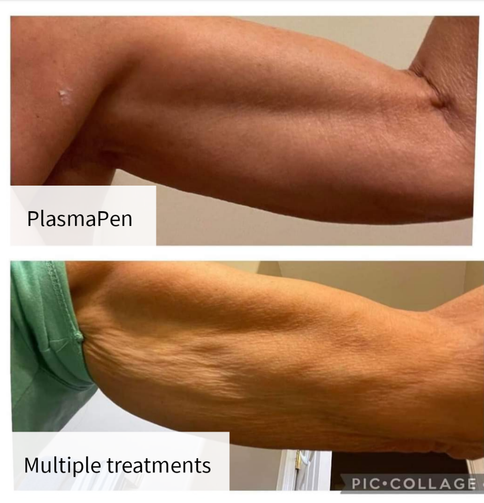 Arms/Non-surgical Brachioplasty