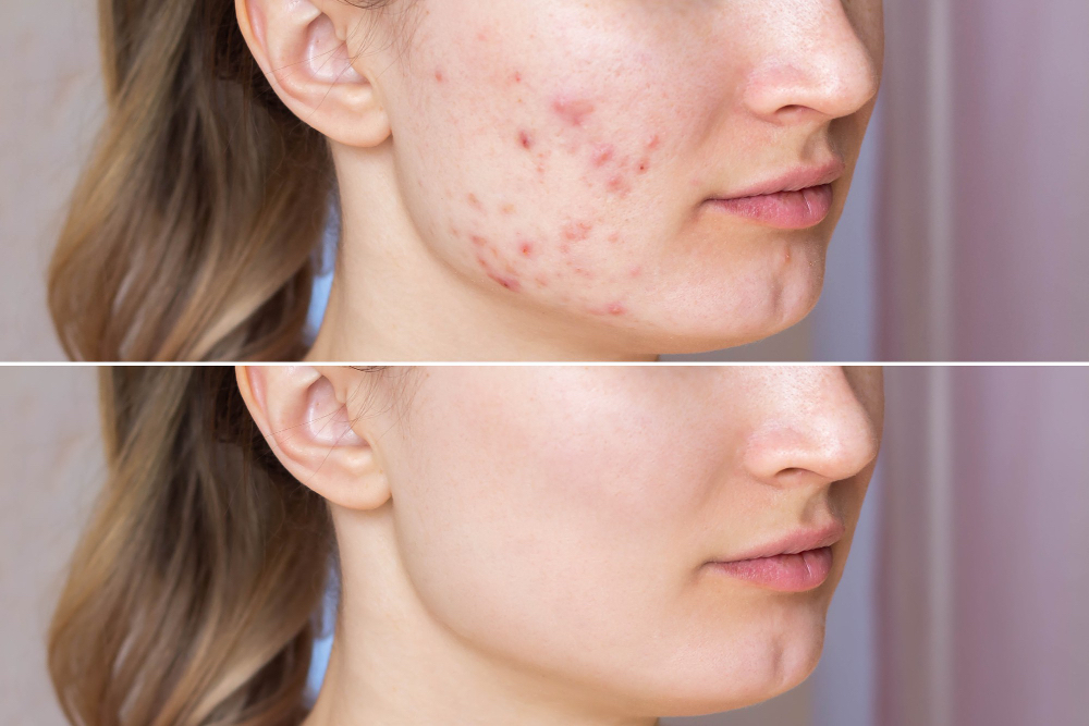 Clinical Acne Facial