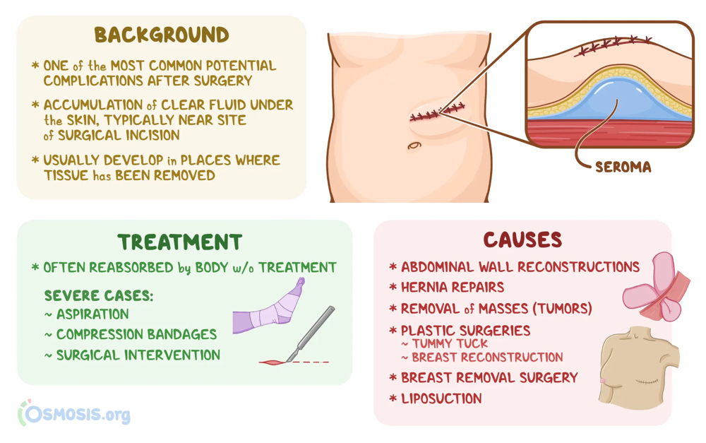 Seroma Drain