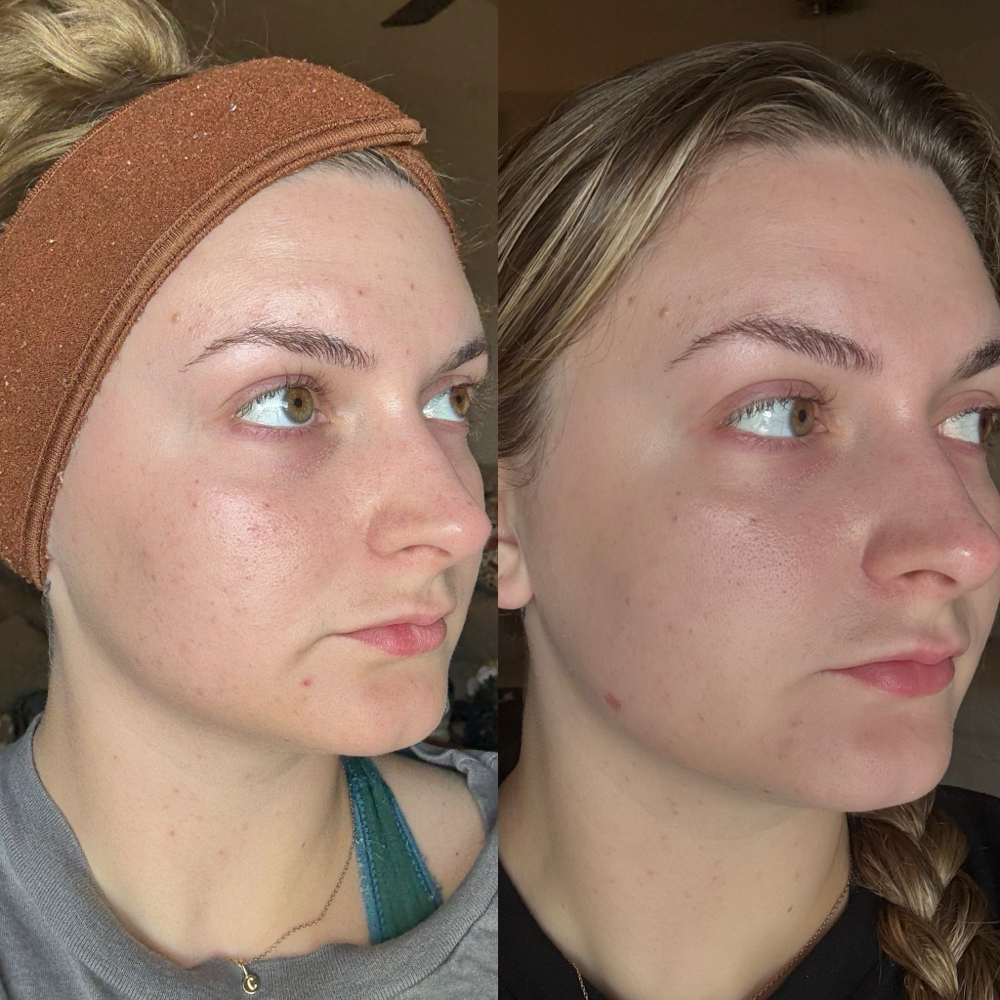 Consult- Liquid Microneed/Chem peel at Taylor’d To You - AWE Skin Studio in Lebanon, TN