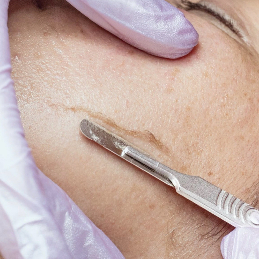 DermaPlane Model Call Facial at Vitality Beauty LLC in Richfield, WI